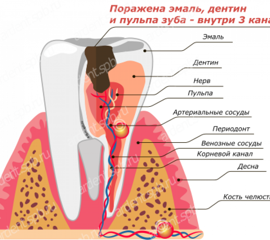 3 канальный зуб. Трехканальный пульпит. Строение трехканального зуба. Двухканальный пульпит.